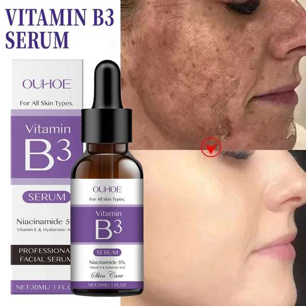 Niacinamide Face Serum – Vitamin B3 Brightening Serum for Dark Spots, Uneven Skin Tone & Fine Lines